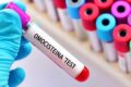 Omocisteina, il filo rosso tra metabolismo, genetica e medicina di genere: a Catania